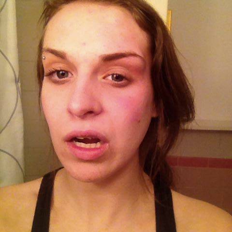 The student posted a photo of her injuries on Facebook following the attack. The Journal has obtained permission from the victim to publish this photo.