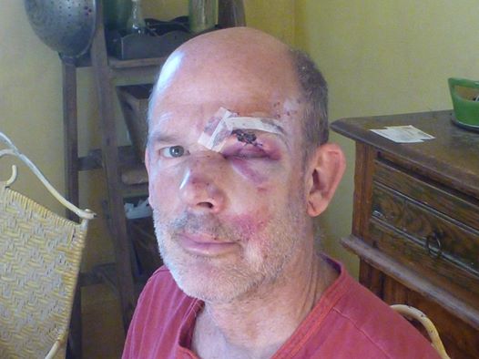 Noble suffered a serious concussion