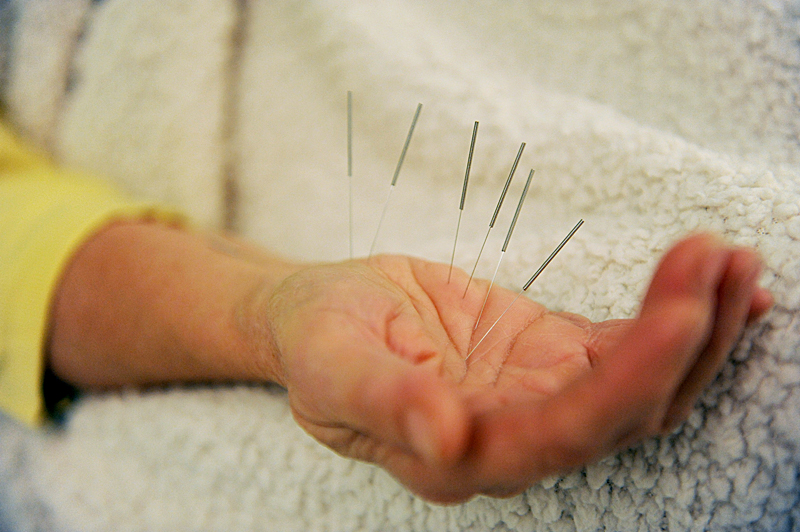 The finer points of acupuncture The Queen's Journal
